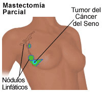 Dibujo de una mastectomía parcial