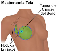 Dibujo de una mastectomía total