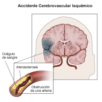 Ilustración de un accidente cerebrovascular isquémico