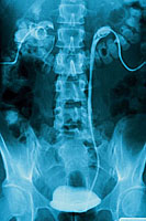 Picture of an intravenous pyelogram film.