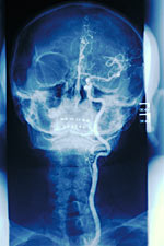 Picture of a carotid angiogram 