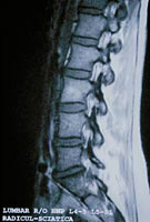 Photo of a CT scan of the spine