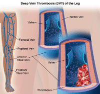 Illustration of deep vein thrombosis of the leg