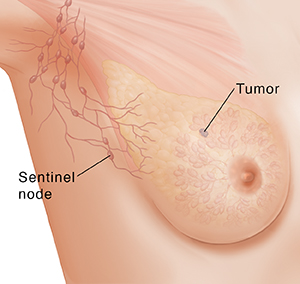 Three-quarter view of female underarm area showing breast anatomy ghosted in. Incisions in underarm and on breast for lumpectomy.