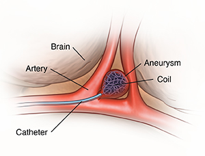 Closeup of aneurysm in brain showing catheter in artery delivering coil into aneurysm.