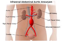 Illustration of infrarenal abdominal aortic aneurysm
