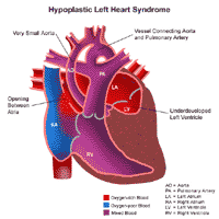 Anatomy of a heart with hypoplastic left heart syndrome