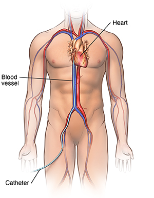 Front view of male body showing catheter inserted in blood vessel in leg and going into heart.