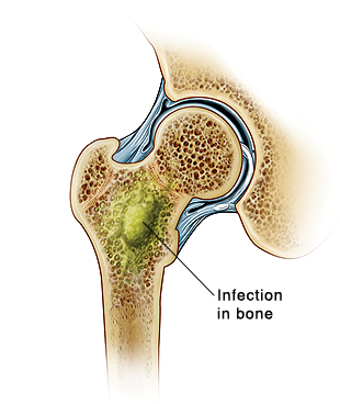 Front view cross section of hip joint showing infection in leg bone.