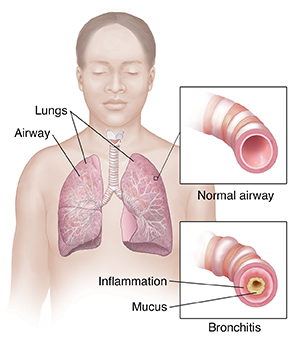 Front view of woman showing respiratory system. Insets show normal airway and airway with bronchitis.