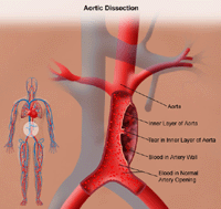 Illustration of aortic dissection