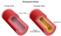 Illustration of a normal and diseased artery