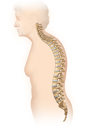 Side view of female body showing spine with kyphosis causing hump in upper back.