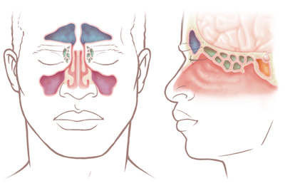 Front and side view of a face showing the sinuses.