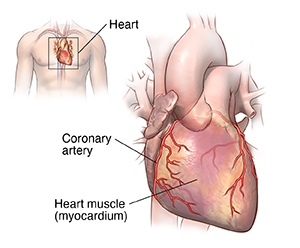 Front view of heart showing coronary arteries and locator of heart in male torso.