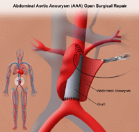 Illustration of open repair of abdominal aortic aneurysm