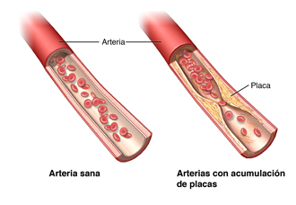 Parte de una arteria con acumulación de placa