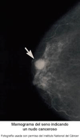 Imagen de mamograma del seno indicando un bulto canceroso
