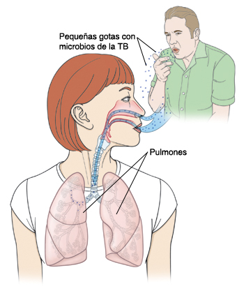 Contorno de la cabeza y el pecho de una mujer, con la cabeza girada hacia un lado. Pueden verse las estructuras internas de la nariz, las vías respiratorias y los pulmones. El hombre en el fondo tose esparciendo microgotas con gérmenes de la tuberculosis. La mujer inhala las microgotas por la nariz hacia los pulmones.