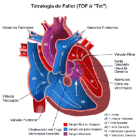 Anatomía de un corazón con tetralogía de Fallot