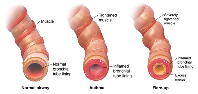 Normal bronchiole, a tightened bronchiole with asthma, and constricted bronchiole with excess mucus during asthma flareup.