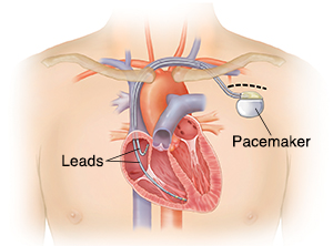 Outline of man's chest showing pacemaker in chest with leads going into heart chambers.