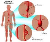 Illustration of types of aneurysms