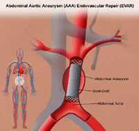 Illustration of endovascular repair of abdominal aortic aneurysm