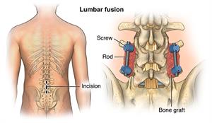 Back view of lumbar vertebrae showing lumbar fusion with locator showing incision location.