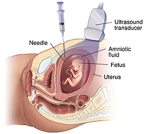Side view of female pelvic area showing amniocentesis.