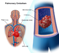 Illustration of a pulmonary embolism