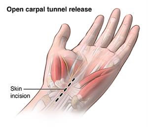 Location of incision for open release surgery.