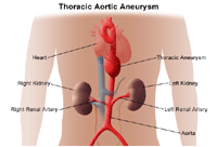 Illustration of thoracic aortic aneurysm
