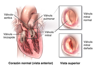 Una válvula mitral rebajada